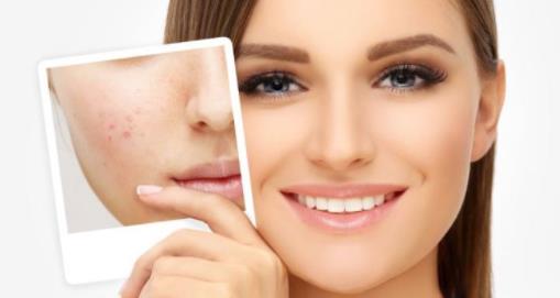 臉上長痘是什么原因 長痘痘了怎么辦 痘痘肌膚怎么改善