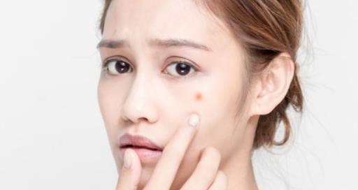 臉上長痘是什么原因 長痘痘了怎么辦 痘痘肌膚怎么改善