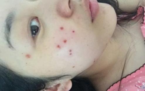 激光去痣后要注意什么?激光去痣有什么危害