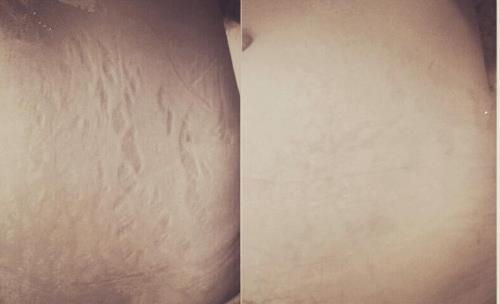 妊娠紋可以完全修復(fù)嗎 妊娠紋可以自己恢復(fù)嗎