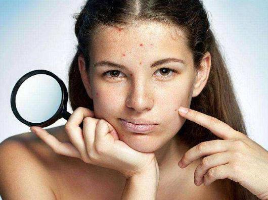 30歲了臉上還長痘痘是怎么回事?青春痘疫苗最新進展