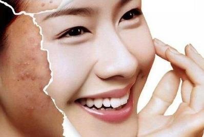 祛痘技巧知道的有哪些?朵嘉濃護膚品祛痘算不算技巧?
