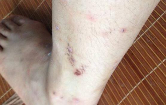 皮膚疤痕一直是困擾著人們的話題 消除皮膚疤痕的方法