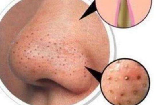 毛孔粗就會有黑頭 祛除黑頭別入這五個(gè)誤區(qū)