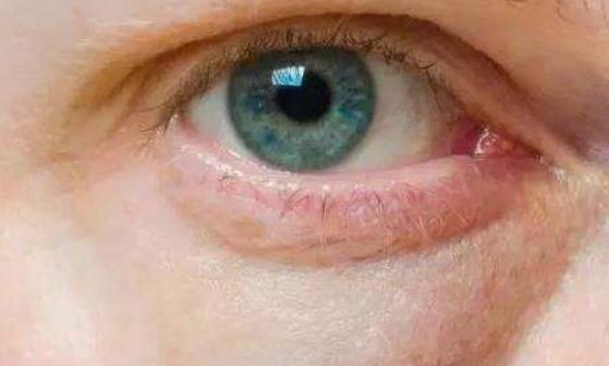 護眼:三步消除眼睛浮腫