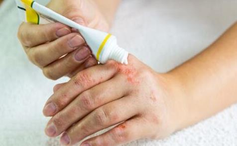 敏感體質的自我檢測方法 過敏性患者該怎么忌口