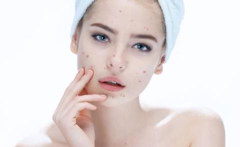 安全健康還你光滑皮膚的祛痘方法 怎樣避免祛痘后留疤