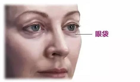 日常該怎么預防眼袋的形成 有眼袋該怎么去眼袋