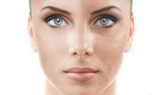 不同問(wèn)題引起的毛孔粗大問(wèn)題處理方法 縮毛孔小妙招