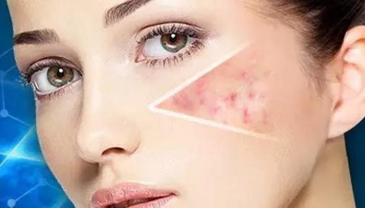 長閉合性粉刺的原因 怎么樣擺脫處理閉合性粉刺