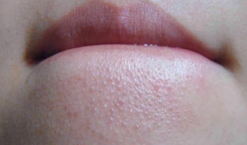 長閉合性粉刺的原因 怎么樣擺脫處理閉合性粉刺