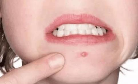 長閉合性粉刺的原因 怎么樣擺脫處理閉合性粉刺