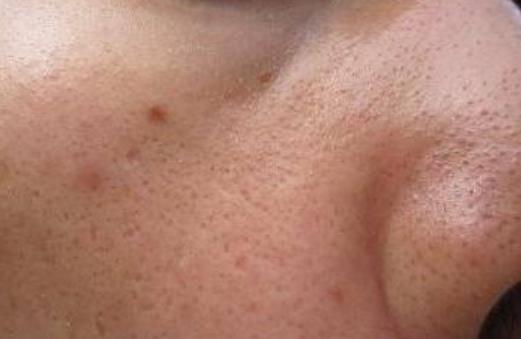 毛孔粗大用食鹽有用嗎 毛孔粗大敷什么面膜好