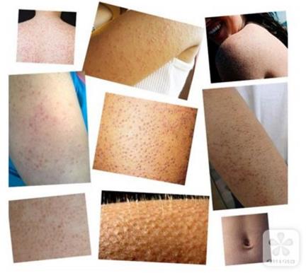 較真:雞皮膚可以根治嗎?去掉雞皮膚要多少錢