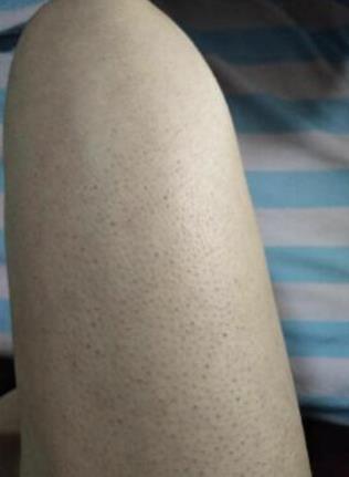 去雞皮膚用什么藥膏最好 親歷體驗更有發言權