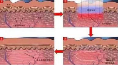 北京伊美爾健翔醫(yī)院:果酸煥膚有危險(xiǎn)嗎