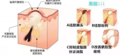北京伊美爾健翔醫(yī)院:果酸煥膚有危險(xiǎn)嗎