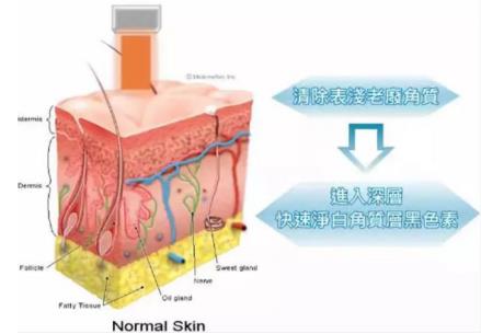 北京伊美爾健翔醫(yī)院:果酸煥膚有危險(xiǎn)嗎