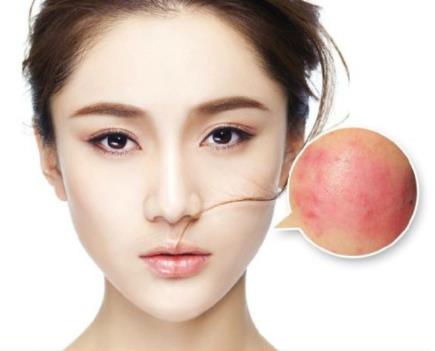 臉上長紅血絲怎么治,臉上的紅血絲越來越重怎么辦