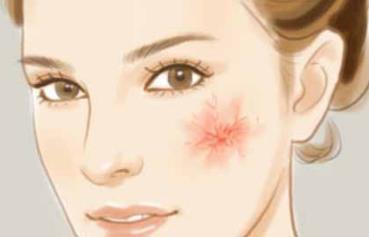 臉上起紅血絲怎么辦,怎么去紅血絲最有效