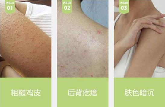 治雞皮膚的藥膏叫什么 有多年護膚管理的老師這么說