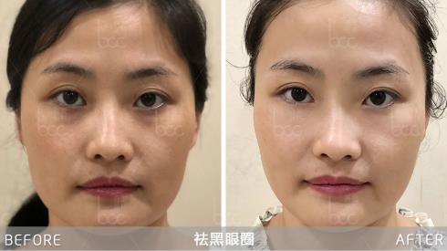 香蜜麗格黎京雄院長Fotona 4D魅眼光雕祛除黑眼圈