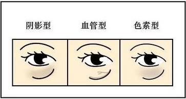 香蜜麗格黎京雄院長Fotona 4D魅眼光雕祛除黑眼圈