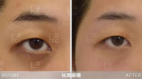 黎京雄院長提醒你:別以為黑眼圈只是熬夜的錯