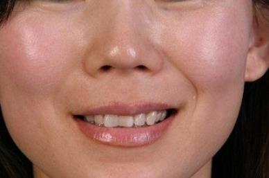 女生法令紋怎么消除 多種方法供你選擇