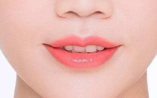 什么是豐唇術 豐唇術能維持多久 豐唇術注意事項