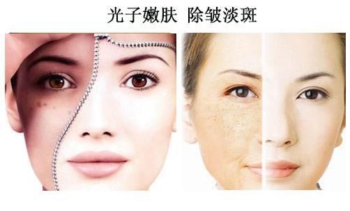 光子去魚尾紋要注意什么?光子嫩膚法祛痘印效果好嗎