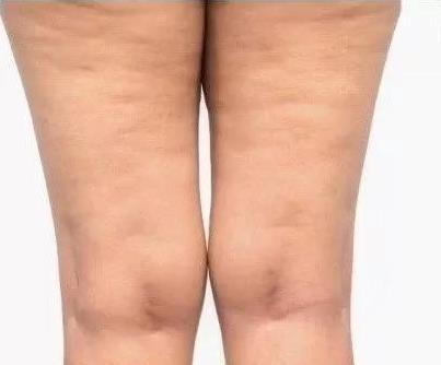 普羅普姿張正鵬院長拒絕吸脂凹凸不平