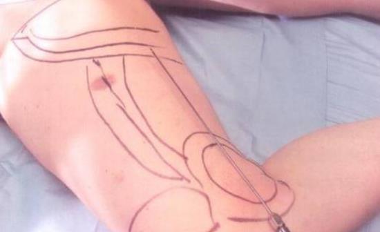 ���ȳ�֬��û֏ͣ����ȳ�֬�ĺ��z�Y����Щ��