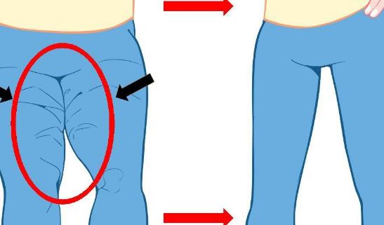 大腿抽脂多久恢復?大腿抽脂的后遺癥有哪些?