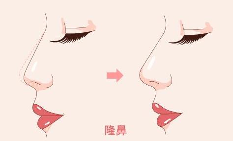 什么樣的人適合隆鼻 注射玻尿酸隆鼻該注意什么