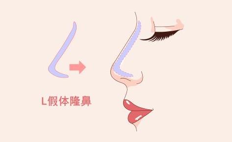 什么樣的人適合隆鼻 注射玻尿酸隆鼻該注意什么