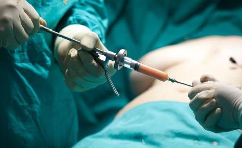 抽脂術的效果和注意事項 在決定抽脂前需要知道的幾件事