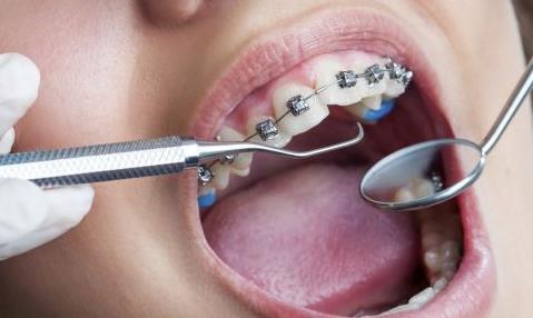 牙齒矯正的最佳年齡 牙齒矯正手術有什么樣的危害
