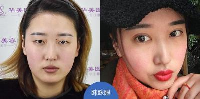 煙臺華美整形醫院開眼角手術安全嗎 追求高品質、高度安全首選