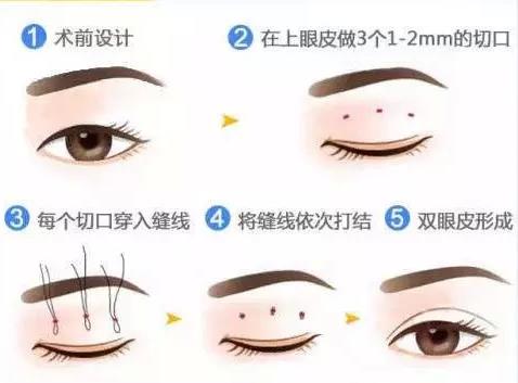 八大處楊欣教授:雙眼皮手術后需要多久才能恢復