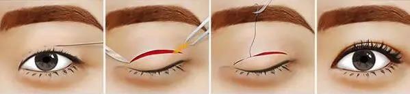 八大處楊欣教授:雙眼皮手術后需要多久才能恢復