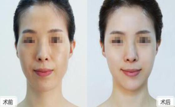 新疆華美整形美容醫院關于面部填充