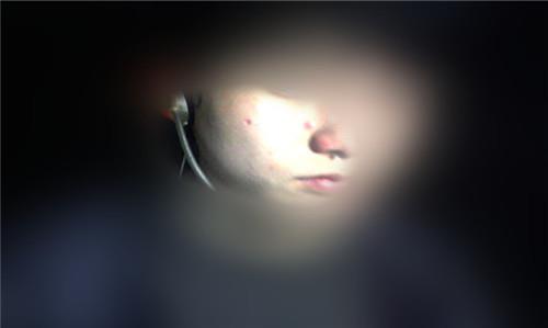 點(diǎn)痣好不好會留疤嗎?點(diǎn)痣后要注意什么