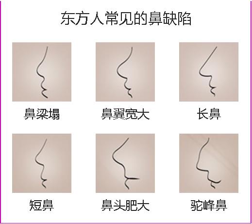 廣州韓妃整形攻略:隆鼻方法哪種好?