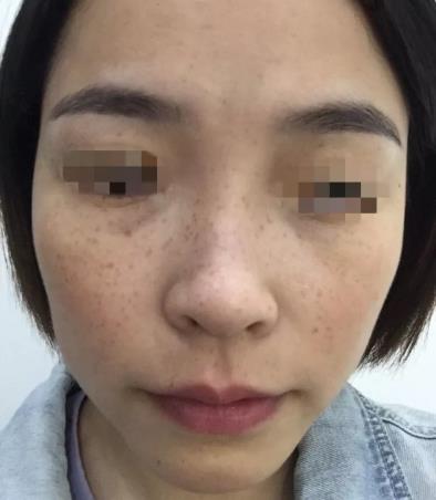 廈門薇格整形醫院皮秒激光如何 幫你解決各種肌膚問題