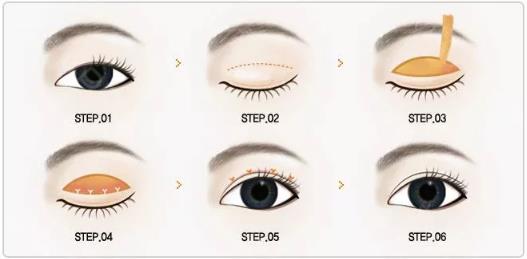 鄭州美萊整形靠譜么 重塑優(yōu)美弧線靈韻精雕大眼