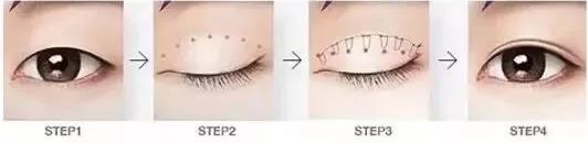 鄭州美萊整形靠譜么 重塑優(yōu)美弧線靈韻精雕大眼