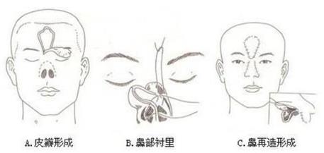 廈門臉博士整形醫院可信嗎 拉斯鼻整形修復技術免費拯救了這個無鼻小孩