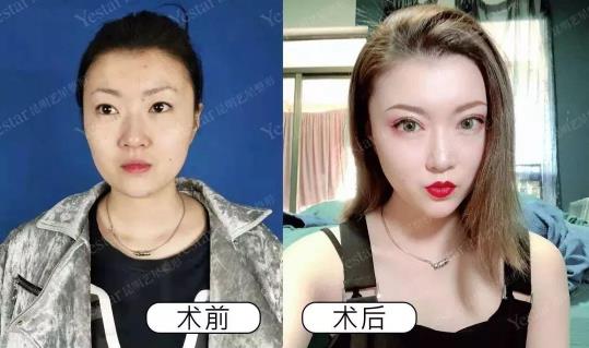 昆明藝星整形做雙眼皮好嗎 美麗獨(dú)秀高貴皇后