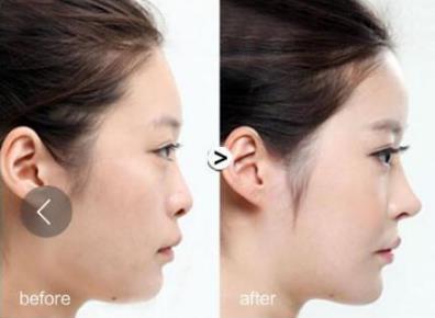 昆明韓辰鼻孔縮小手術(shù) 你蒜頭鼻子的煩惱 我們幫你清除